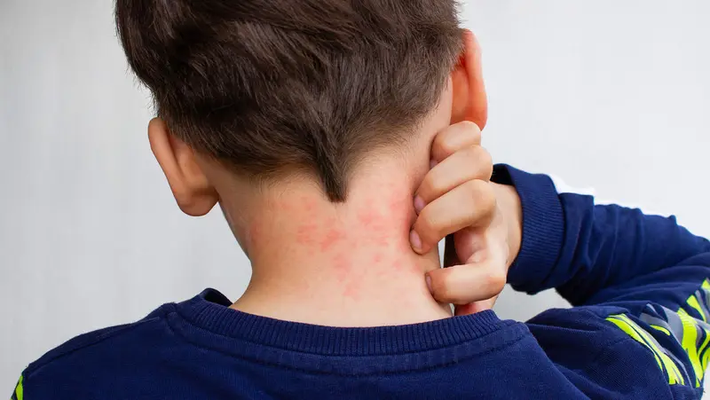 ⚠️🔥💻 ¡Atención, familias! Niño desarrolló el 'síndrome de la piel tostada' por apoyar el portátil hasta 8 horas al día