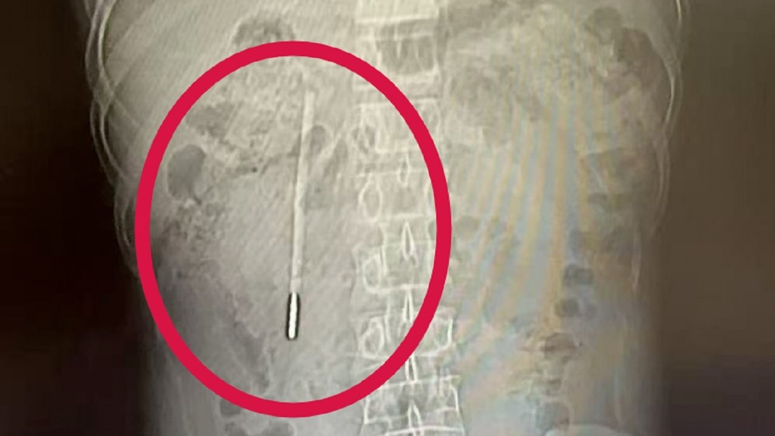 Acude al hospital por un dolor abdominal y le descubren un insólito objeto en su interior