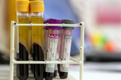 Una nueva prueba de sangre ofrece "una esperanza real" frente a cánceres difíciles de detectar