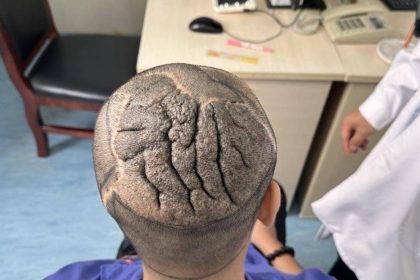 Hombre vivió años con una rara afección que 'convirtió' su cabeza en un cerebro